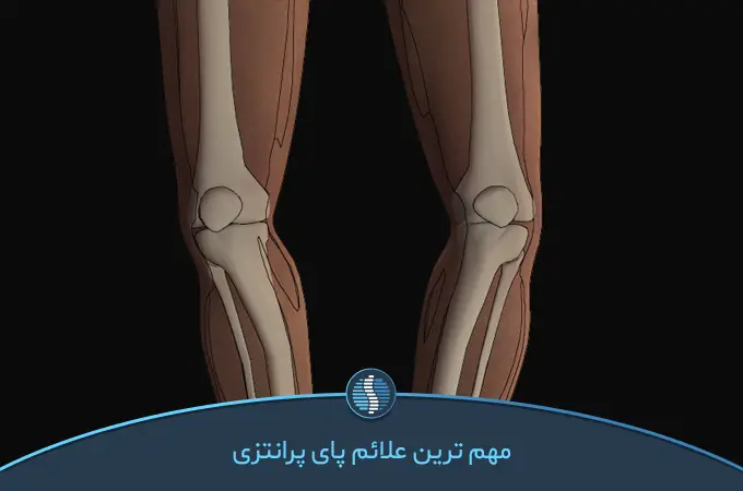 آشنایی با بیماری پای پرانتزی | ژین طب