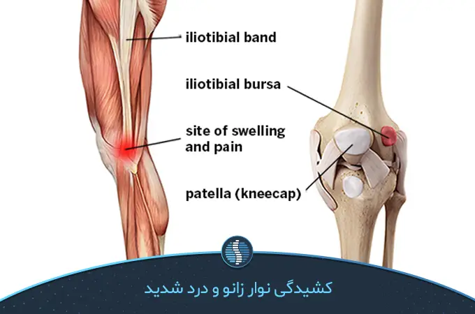 سندروم ایلیوتیبیال علت اصلی زانو درد در ورزشکاران | ژین طب