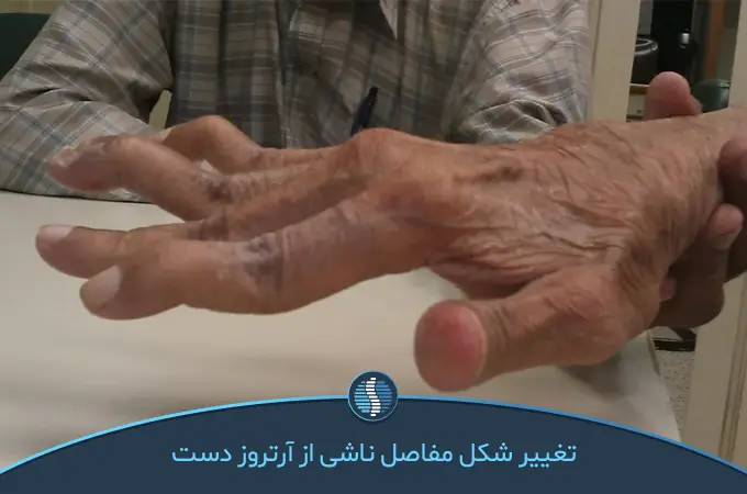 علائم آرتروز انگشتان دست؛ از کجا بفهمم به آرتروز دست مبتلا شده ام؟ | ژین طب