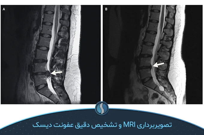 تصویر برداری MRI برای تشخیص عفونت دیسک کمر | ژین طب