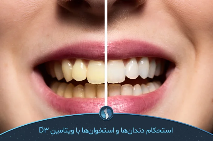 ویتامین D سبب استحکام دندان و استخوان‌ها می‌شود | ژین طب