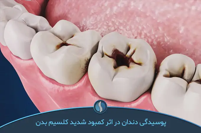 پوسیدگی درمان دندانی یکی از مهم‌ترین نشانه های کمبود کلسیم و منزیم | ژین طب