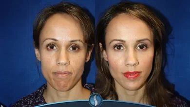 قبل و بعد صورتی برای چاق شدن صورت و زیر چشم | ژین طب