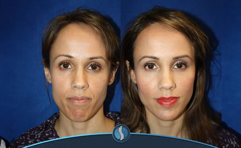 قبل و بعد صورتی برای چاق شدن صورت و زیر چشم | ژین طب