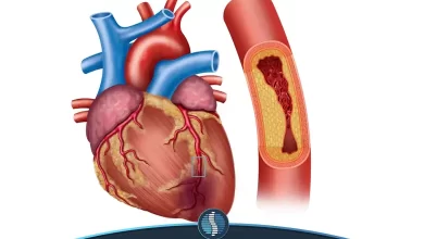آناتومی قلبی که دچار انسداد رگ شده است | ژین طب