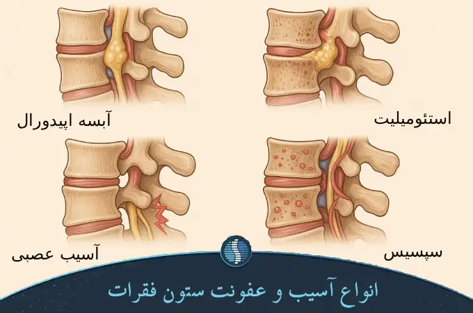 انواع عفونت ستون فقرات