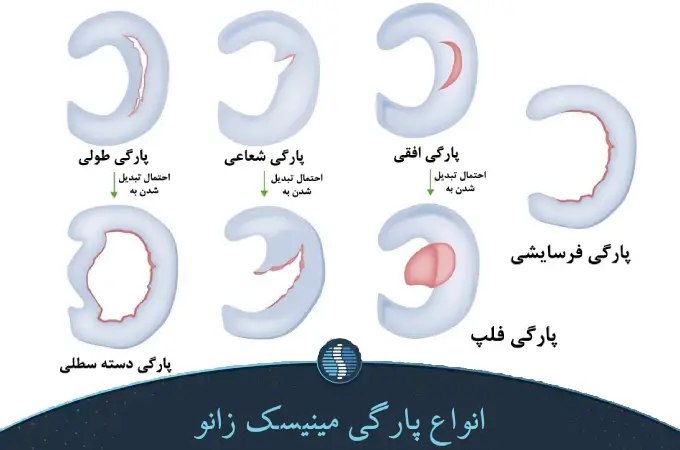 انواع پارگی مینیسک زانو