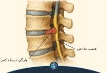پارکی دیسک کمر