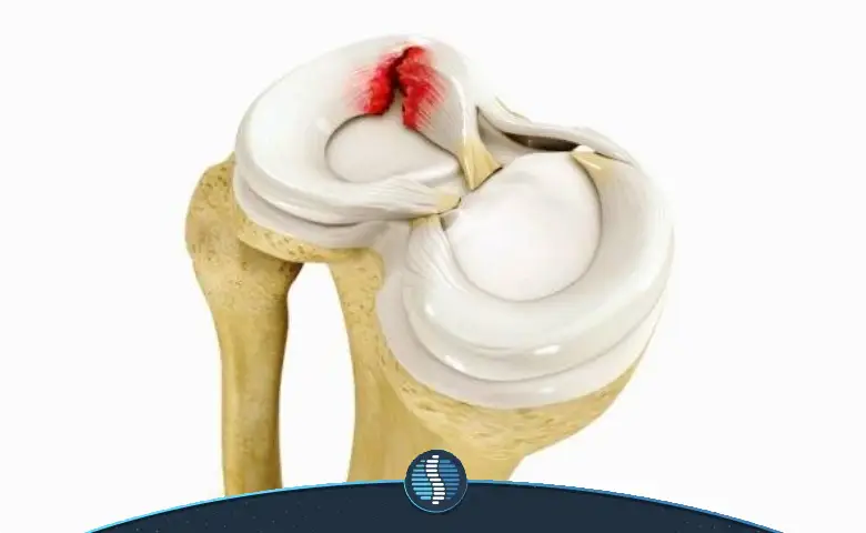 پارگی مینیسک زانو