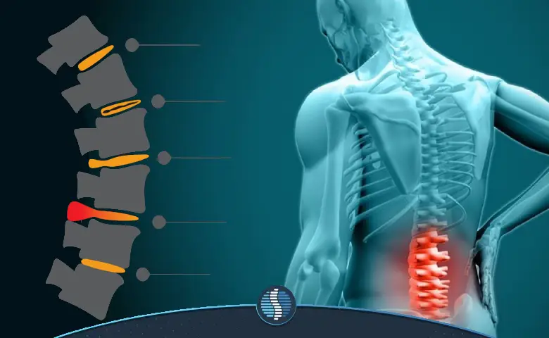 انواع دیسک کمر