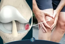 ترمیم پارگی مینیسک زانو
