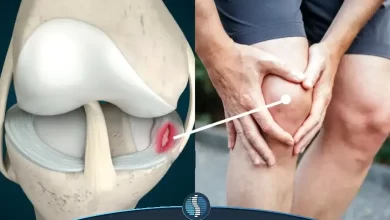 ترمیم پارگی مینیسک زانو