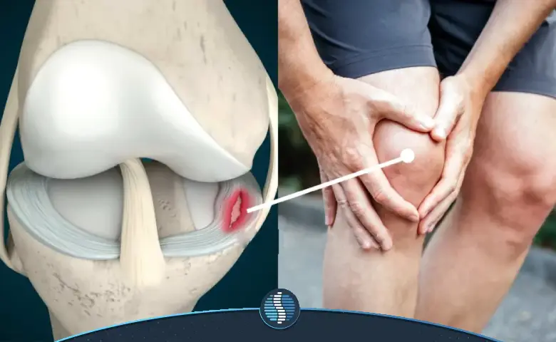 ترمیم پارگی مینیسک زانو