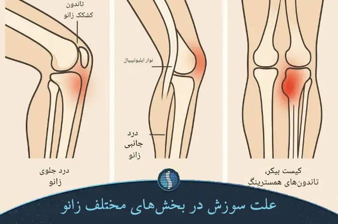 علت سوزش در بخش_های مختلف زانو