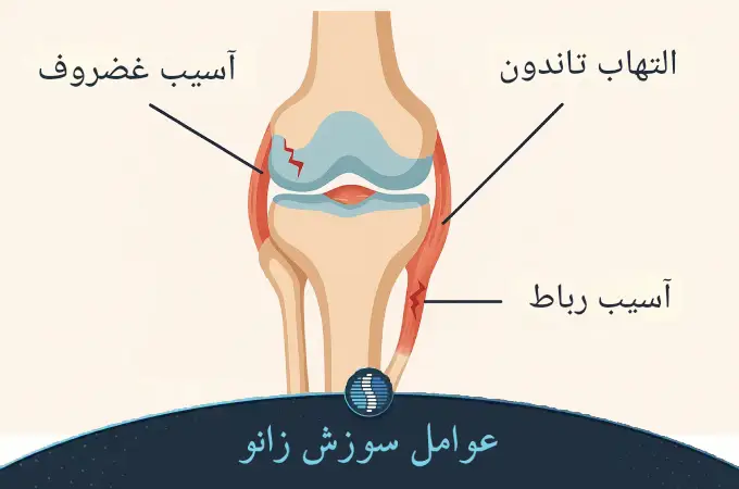 عوامل سوزش زانو
