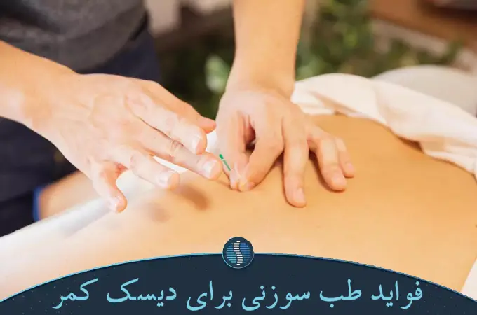فواید طب سوزنی برای دیسک کمر