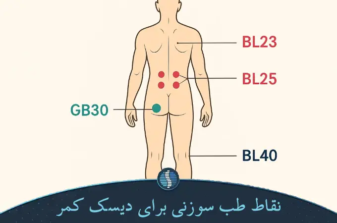 نقاط طب سوزنی برای دیسک کمر