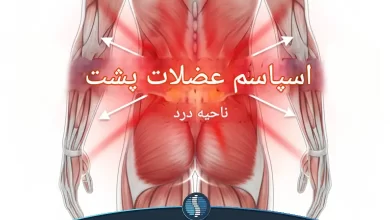 اسپاسم و گرفتگی عضلات کمر
