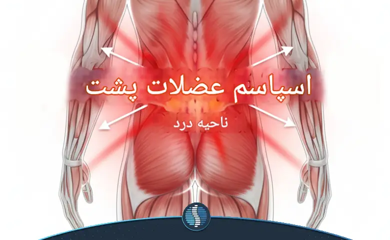 اسپاسم و گرفتگی عضلات کمر